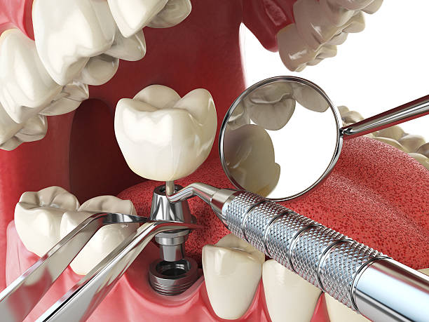 Best Emergency Dental Care for Broken or Chipped Teeth in South Whittier, CA
